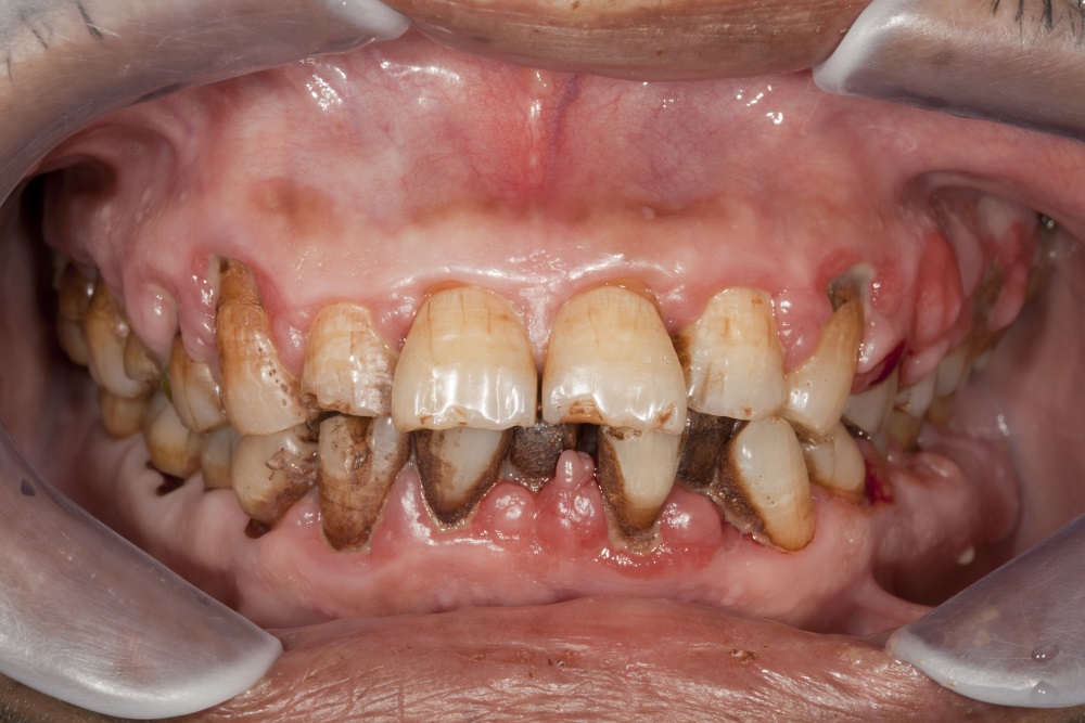 periodontitis-linked-to-increased-dementia-risk