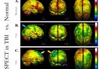 Advanced Neuroimaging Can Guide Interventions in Traumatic Brain Injury Advanced Neuroimaging Can Guide Interventions in Traumatic Brain Injury