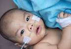 Vigabatrin Plus Hormonal Therapy Superior in Infantile Spasms Vigabatrin Plus Hormonal Therapy Superior in Infantile Spasms