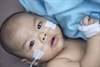 Vigabatrin Plus Hormonal Therapy Superior in Infantile Spasms Vigabatrin Plus Hormonal Therapy Superior in Infantile Spasms