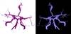 Glucocorticoids May Worsen Reversible Cerebral Vasoconstriction Syndrome Glucocorticoids May Worsen Reversible Cerebral Vasoconstriction Syndrome