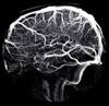 Reconsidering the Vascular Hypothesis of Migraine Pathophysiology Reconsidering the Vascular Hypothesis of Migraine Pathophysiology