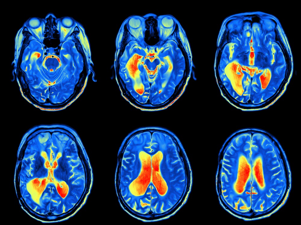 guidelines-for-using-fmri-for-presurgical-evaluation-of-epilepsy