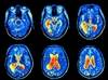 Using fMRI to Uncover Cognitive Dysfunction in Systemic Lupus Erythematosus Using fMRI to Uncover Cognitive Dysfunction in Systemic Lupus Erythematosus