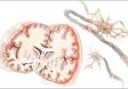 In TBI, Memantine May Reduce Neuronal Damage In TBI, Memantine May Reduce Neuronal Damage