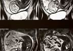 MRI Improves Diagnostic Accuracy of Fetal Brain Abnormalities MRI Improves Diagnostic Accuracy of Fetal Brain Abnormalities