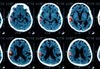 Higher Risk for Symptomatic Intracranial Hemorrhage After Endovascular Treatment for Stroke Higher Risk for Symptomatic Intracranial Hemorrhage After Endovascular Treatment for Stroke