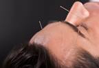 Acupuncture Reduces Pain Intensity in Idiopathic Trigeminal Neuralgia Acupuncture Reduces Pain Intensity in Idiopathic Trigeminal Neuralgia