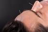 Acupuncture Reduces Pain Intensity in Idiopathic Trigeminal Neuralgia Acupuncture Reduces Pain Intensity in Idiopathic Trigeminal Neuralgia