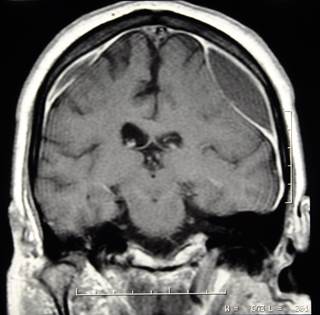 The highest odds of subdural hematoma were found for the combined use of vitamin K antagonists and antiplatelet drugs. The highest odds of subdural hematoma were found for the combined use of vitamin K antagonists and antiplatelet drugs.