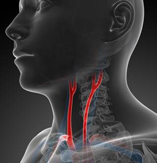 A consistent association was established between migraine and ischemic stroke caused by cervical artery dissection.