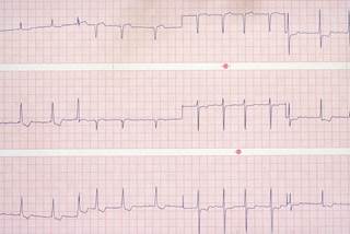 Patients with atrial fibrillation without stroke should be screened for cognitive decline. Patients with atrial fibrillation without stroke should be screened for cognitive decline.
