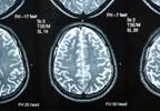 In Traumatic Brain Injury, White Matter Diffusivity May Predict Long Term Outcomes In Traumatic Brain Injury, White Matter Diffusivity May Predict Long Term Outcomes