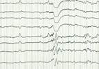 Seizure Frequency May Lessen With Stress Reduction Seizure Frequency May Lessen With Stress Reduction