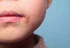 Pediatric Multiple Sclerosis Linked to Epstein-Barr, Herpes Simplex Virus Exposure Pediatric Multiple Sclerosis Linked to Epstein-Barr, Herpes Simplex Virus Exposure