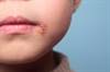 Pediatric Multiple Sclerosis Linked to Epstein-Barr, Herpes Simplex Virus Exposure Pediatric Multiple Sclerosis Linked to Epstein-Barr, Herpes Simplex Virus Exposure