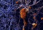 β-Amyloid Accumulation Linked to Excessive Daytime Sleepiness β-Amyloid Accumulation Linked to Excessive Daytime Sleepiness
