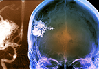 Predicting Hemorrhage Risk in Patients With Vascular Malformations Predicting Hemorrhage Risk in Patients With Vascular Malformations