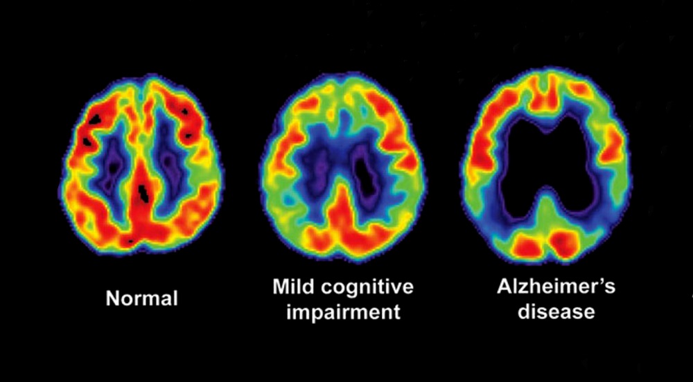 Rest turmoil can be an early indication of Alzheimer's infection