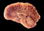 Deep Brain Stimulation Reduces Risk of Polypharmacy in Parkinson's Deep Brain Stimulation Reduces Risk of Polypharmacy in Parkinson's