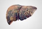Cirrhosis Associated With Increased Stroke Risk Cirrhosis Associated With Increased Stroke Risk
