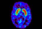 Erectile Dysfunction May Predict Development of Parkinson's Disease Erectile Dysfunction May Predict Development of Parkinson's Disease