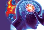 Migraine-Associated Stroke Not Associated With Atherosclerosis Migraine-Associated Stroke Not Associated With Atherosclerosis
