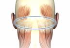 Greater Occipital Nerve Block Effective for Acute Relief of Refractory Migraine Greater Occipital Nerve Block Effective for Acute Relief of Refractory Migraine