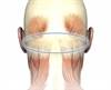 Greater Occipital Nerve Block Effective for Acute Relief of Refractory Migraine Greater Occipital Nerve Block Effective for Acute Relief of Refractory Migraine