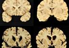 Chronic Traumatic Encephalopathy Uncommon in Treatment-Refractory Epilepsy Chronic Traumatic Encephalopathy Uncommon in Treatment-Refractory Epilepsy