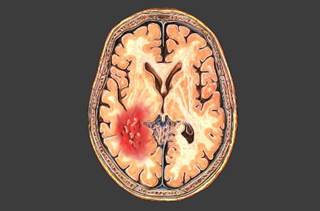 Certain historical features may be specifically associated with subarachnoid hemorrhage. Certain historical features may be specifically associated with subarachnoid hemorrhage.