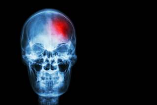 Discharge medications for participants hospitalized for an ischemic stroke as part of follow-up during the REGARDS study were analyzed. Discharge medications for participants hospitalized for an ischemic stroke as part of follow-up during the REGARDS study were analyzed.