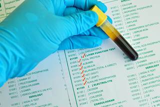 Cannabidiol is being studied as a potential treatment for severe refractory epilepsy syndromes. Cannabidiol is being studied as a potential treatment for severe refractory epilepsy syndromes.