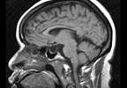 CSF Pressure Not Directly Linked to Headache in Idiopathic Intracranial Hypertension CSF Pressure Not Directly Linked to Headache in Idiopathic Intracranial Hypertension
