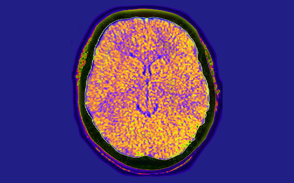 cerebral-edema