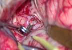 Awake Neurologic Testing During Aneurysm Repair Decreases Ischemic Injury Risk Awake Neurologic Testing During Aneurysm Repair Decreases Ischemic Injury Risk