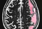 Noncontrast CT Markers Predict Hematoma Growth Risk in Hemorrhagic Stroke Noncontrast CT Markers Predict Hematoma Growth Risk in Hemorrhagic Stroke