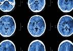 Apixaban Not Superior to Warfarin for Reducing Stroke Risk in Atrial Fibrillation Apixaban Not Superior to Warfarin for Reducing Stroke Risk in Atrial Fibrillation
