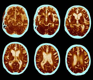 No association was found between risk for Alzheimer disease and treatment with ADT. No association was found between risk for Alzheimer disease and treatment with ADT.