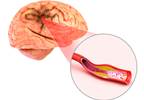 Post-Recanalization Stroke Score More Effective Than Baseline Score for Predicting 3-Month Outcome Post-Recanalization Stroke Score More Effective Than Baseline Score for Predicting 3-Month Outcome