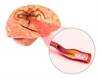 Post-Recanalization Stroke Score More Effective Than Baseline Score for Predicting 3-Month Outcome Post-Recanalization Stroke Score More Effective Than Baseline Score for Predicting 3-Month Outcome