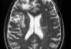 Hypoalgesia, Hyperalgesia Linked to Multiple Sclerosis Lesion Location Hypoalgesia, Hyperalgesia Linked to Multiple Sclerosis Lesion Location