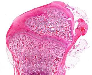 Children taking antiepileptics may be at greater risk for bone fracture. Children taking antiepileptics may be at greater risk for bone fracture.