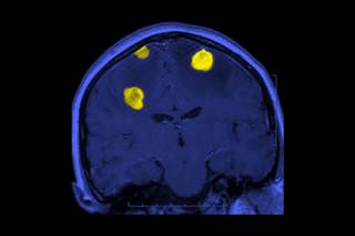 Patients with MBM were younger and had a lower frequency of regional metastasis. Patients with MBM were younger and had a lower frequency of regional metastasis.