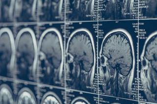 Results from the data showed that patients in Group 1 had a 45.1% lower risk of conversion to CDMS than those in Group 3. Results from the data showed that patients in Group 1 had a 45.1% lower risk of conversion to CDMS than those in Group 3.