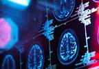Aging-Related Brain Changes No Different in HIV Positive, Negative Aging-Related Brain Changes No Different in HIV Positive, Negative