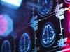 Aging-Related Brain Changes No Different in HIV Positive, Negative Aging-Related Brain Changes No Different in HIV Positive, Negative