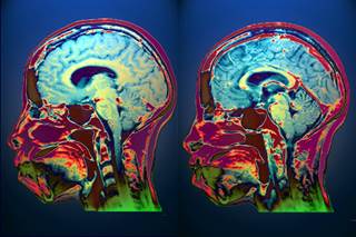 The central nervous system and cranial nerves are predominantly affected in neurosarcoidosis. The central nervous system and cranial nerves are predominantly affected in neurosarcoidosis.