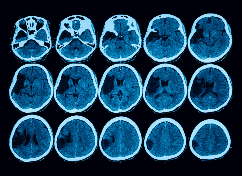 ultra-early-neurological-deterioration-common-in-stroke