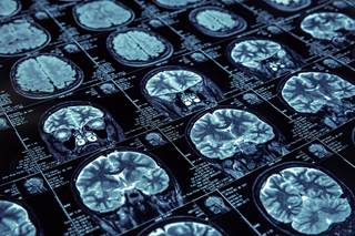 “Cerebral 23Na MRI may be a potential imaging tool for the diagnosis of migraine.” “Cerebral 23Na MRI may be a potential imaging tool for the diagnosis of migraine.”